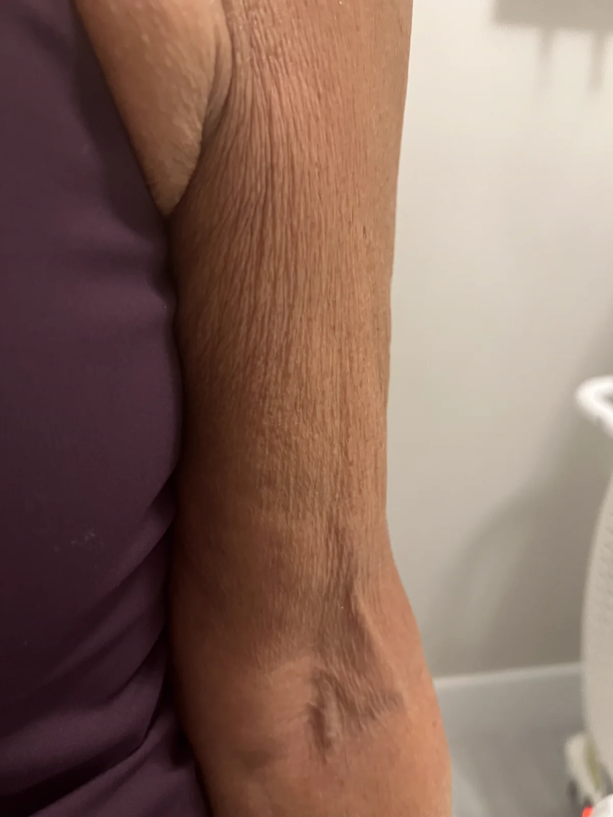 Client's upper arm before treatment