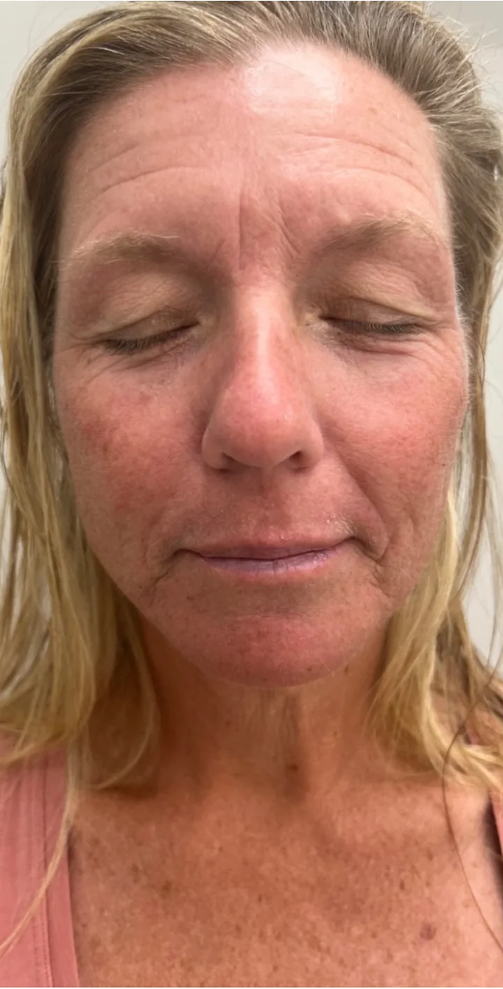 Client's face before treatment